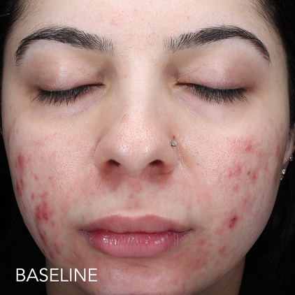 Before and after 1_baseline