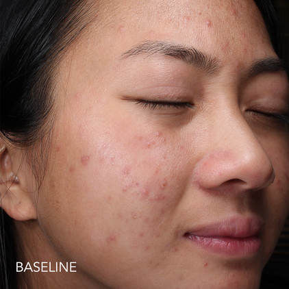 Before and after 3_baseline