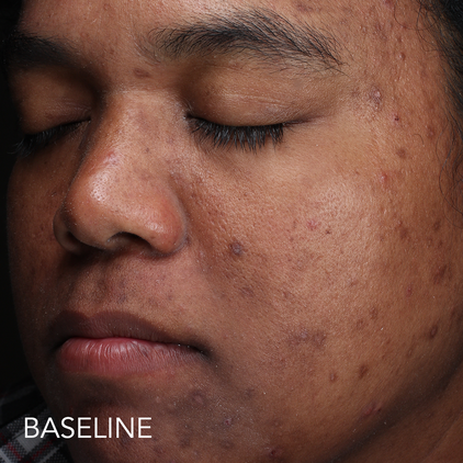 Before and after 2_baseline