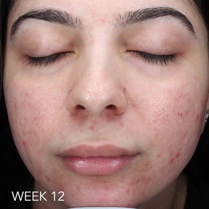 Before and after 1_week 12