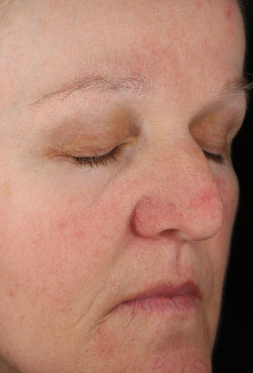 Rozatrol&reg;  before-after-3