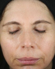 Before and After Image of results from 2 weeks of Renewal Crème Usage