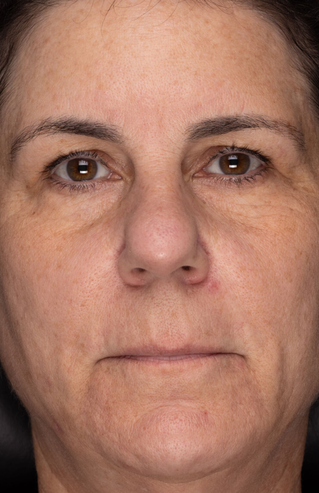 Recovery Cr&egrave;me  before-after-3