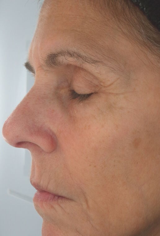 12 weeks after using firming serum