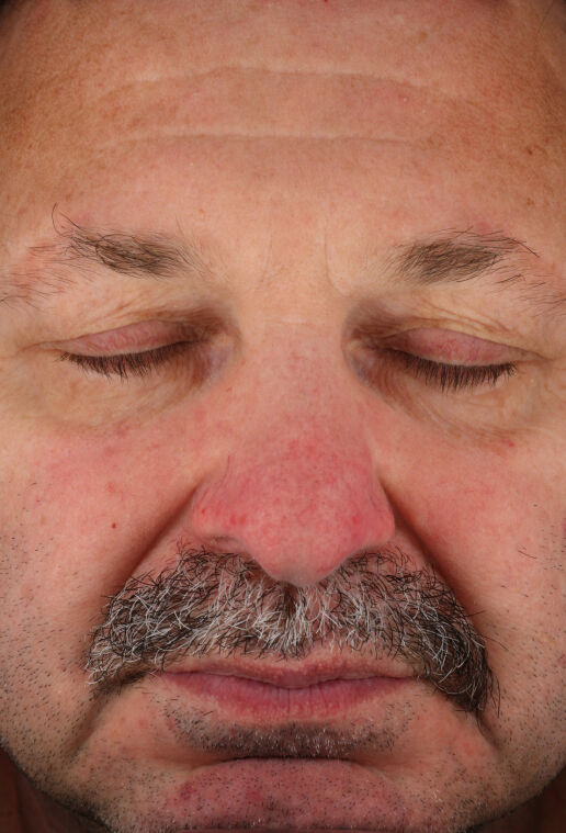 Rozatrol&reg;  before-after-2