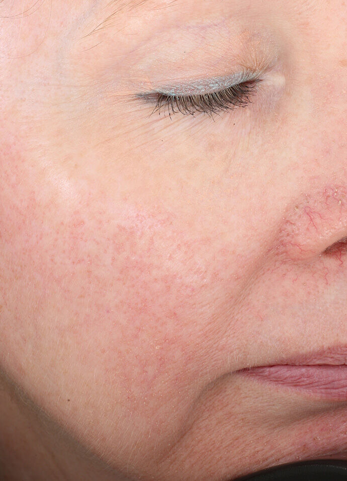 Rozatrol®  before-after-2