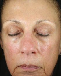 Before and After Image of results from 2 weeks of Renewal Crème Usage