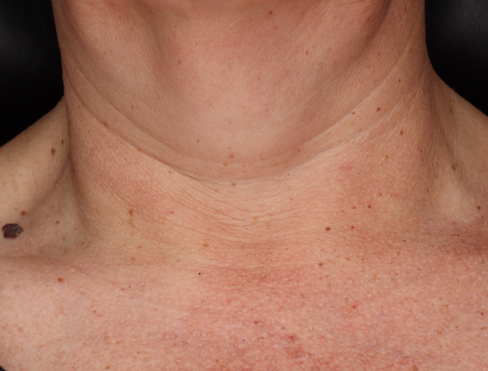 Neck Complex Anti-Aging + Brightening Serum  before-after-1