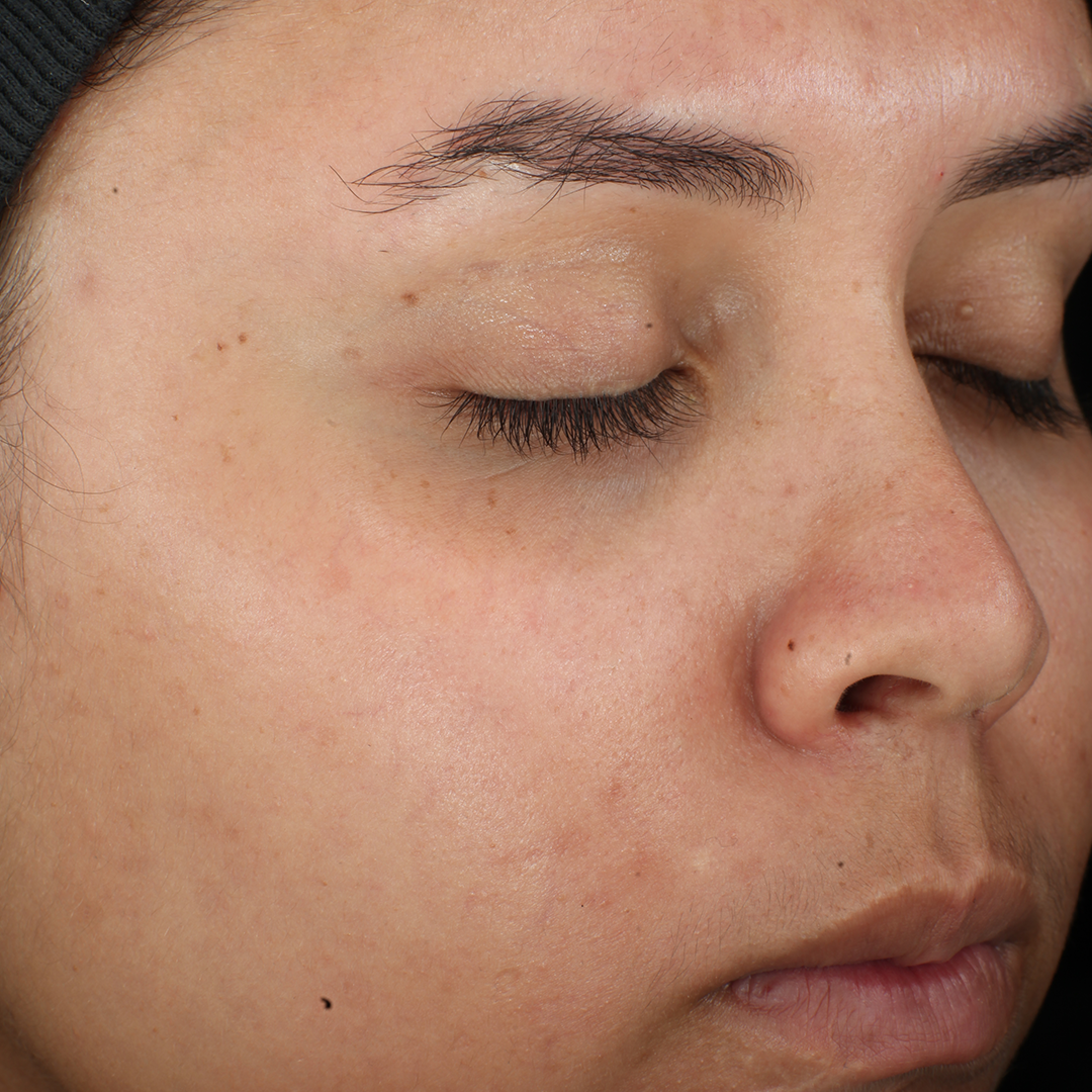 Complexion Clarifying Serum  before-after-2