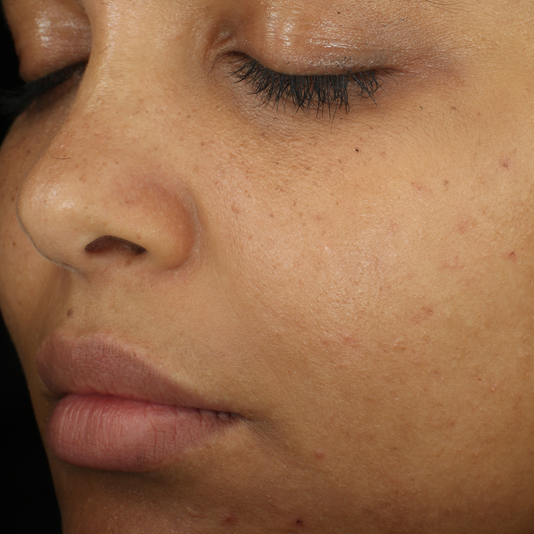 Complexion Clarifying Serum  before-after-4