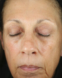 Before and After Image of results from 2 weeks of Renewal Crème Usage