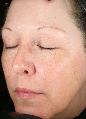 Before and After results from using Brightalive® for 16 weeks