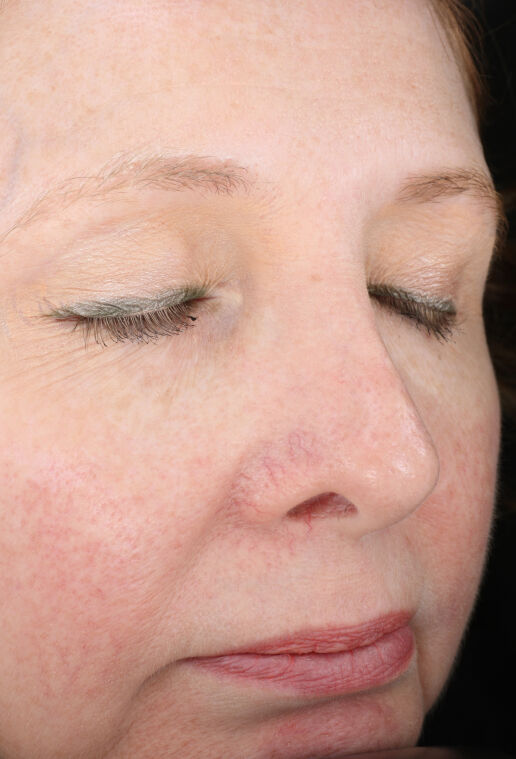 Rozatrol&reg;  before-after-1