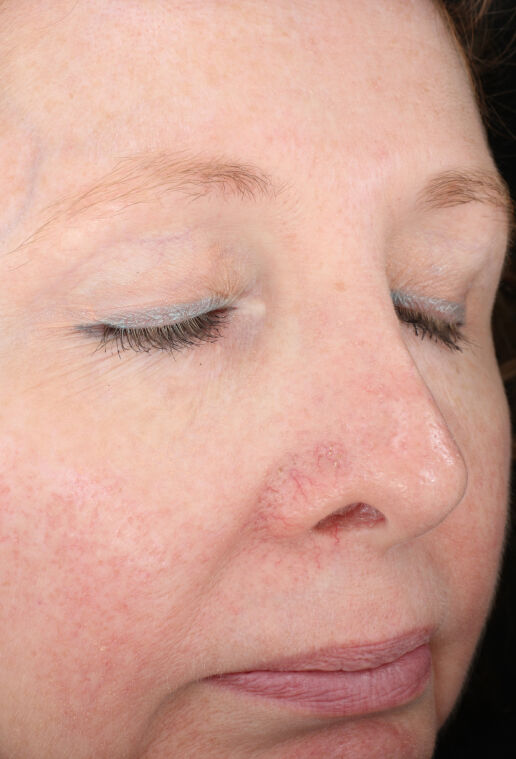 Rozatrol&reg;  before-after-1