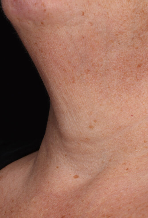 Neck Complex Anti-Aging + Brightening Serum  before-after-2