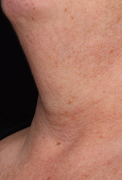 Neck Complex Anti-Aging + Brightening Serum  before-after-2