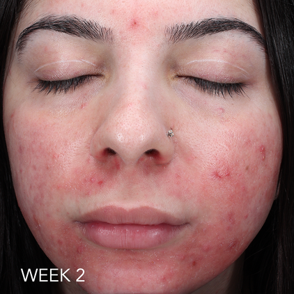 Before and after 1_week 2