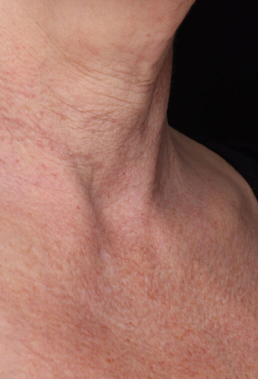 Neck Complex Anti-Aging + Brightening Serum  before-after-3