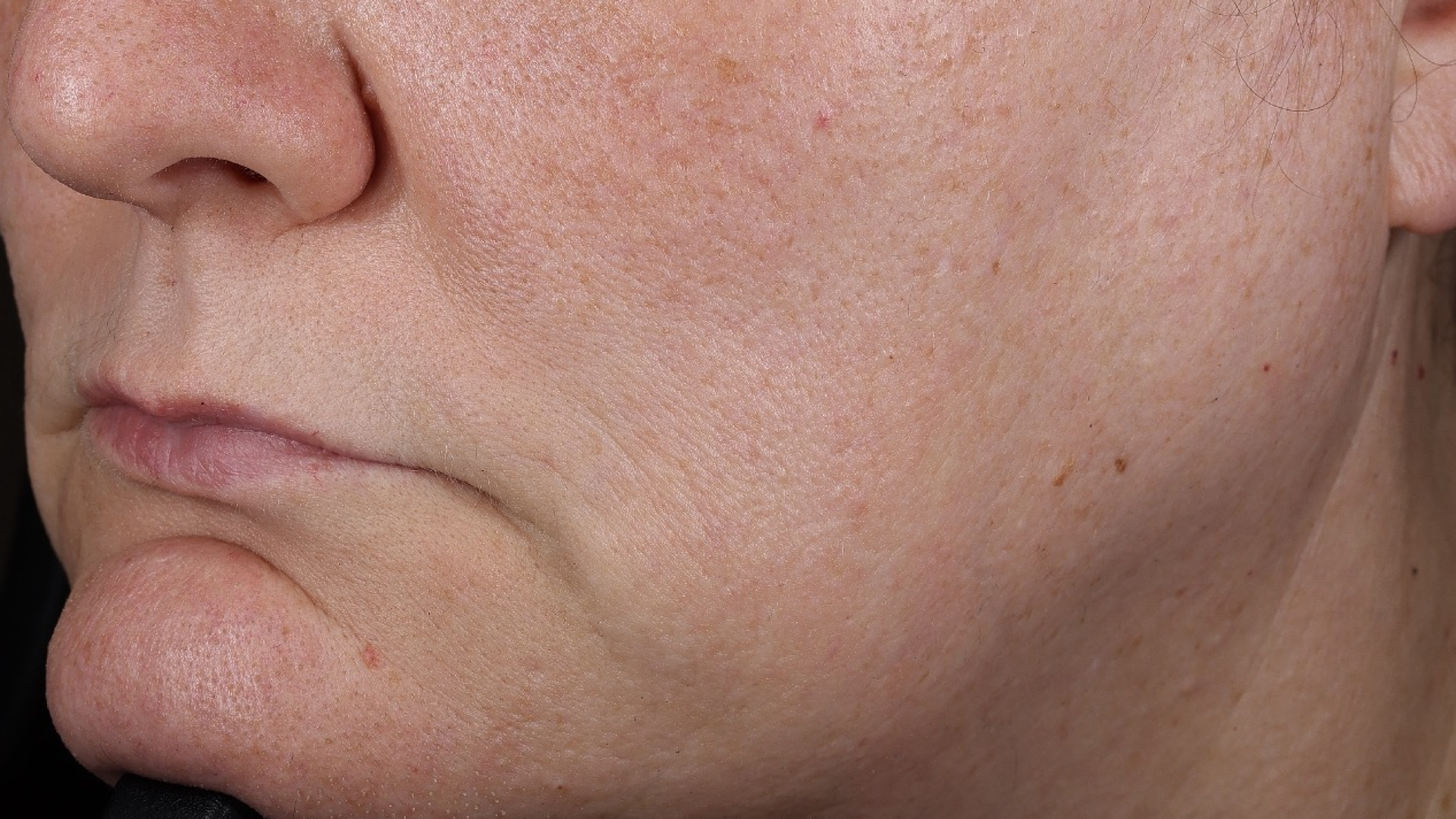 Wrinkle + Texture 0.3  before-after-3