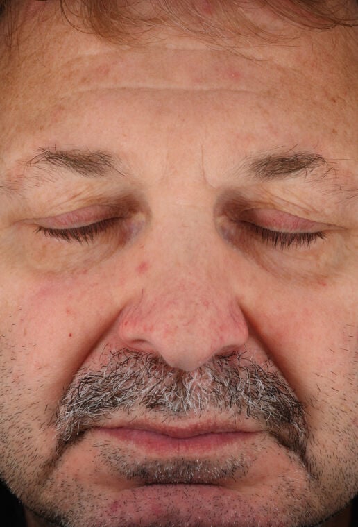 Rozatrol&reg;  before-after-2