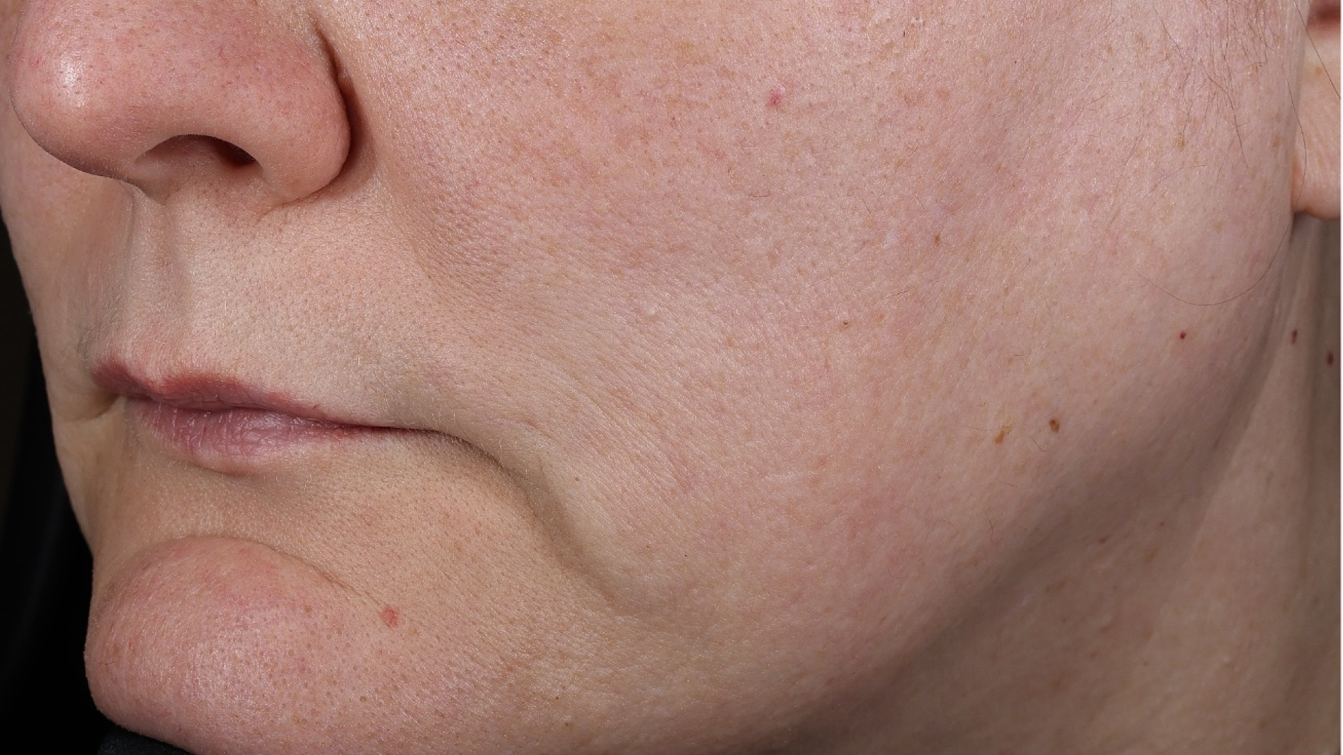 Wrinkle + Texture 0.3  before-after-3