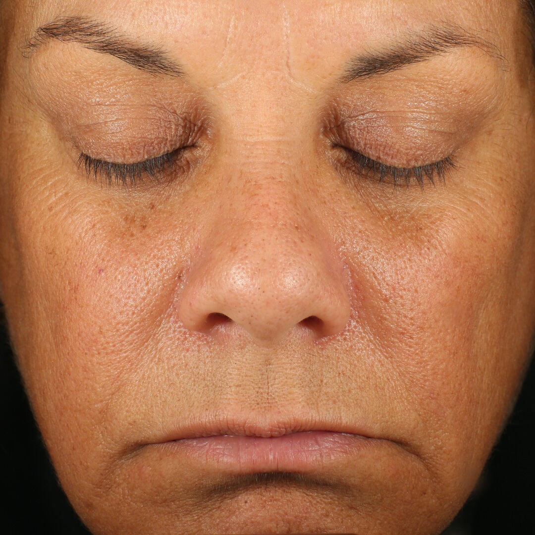 Retinol Skin Brightener 1 Percent  before-after-1