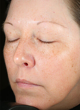 Brightalive&reg; (Travel Size)  before-after-2
