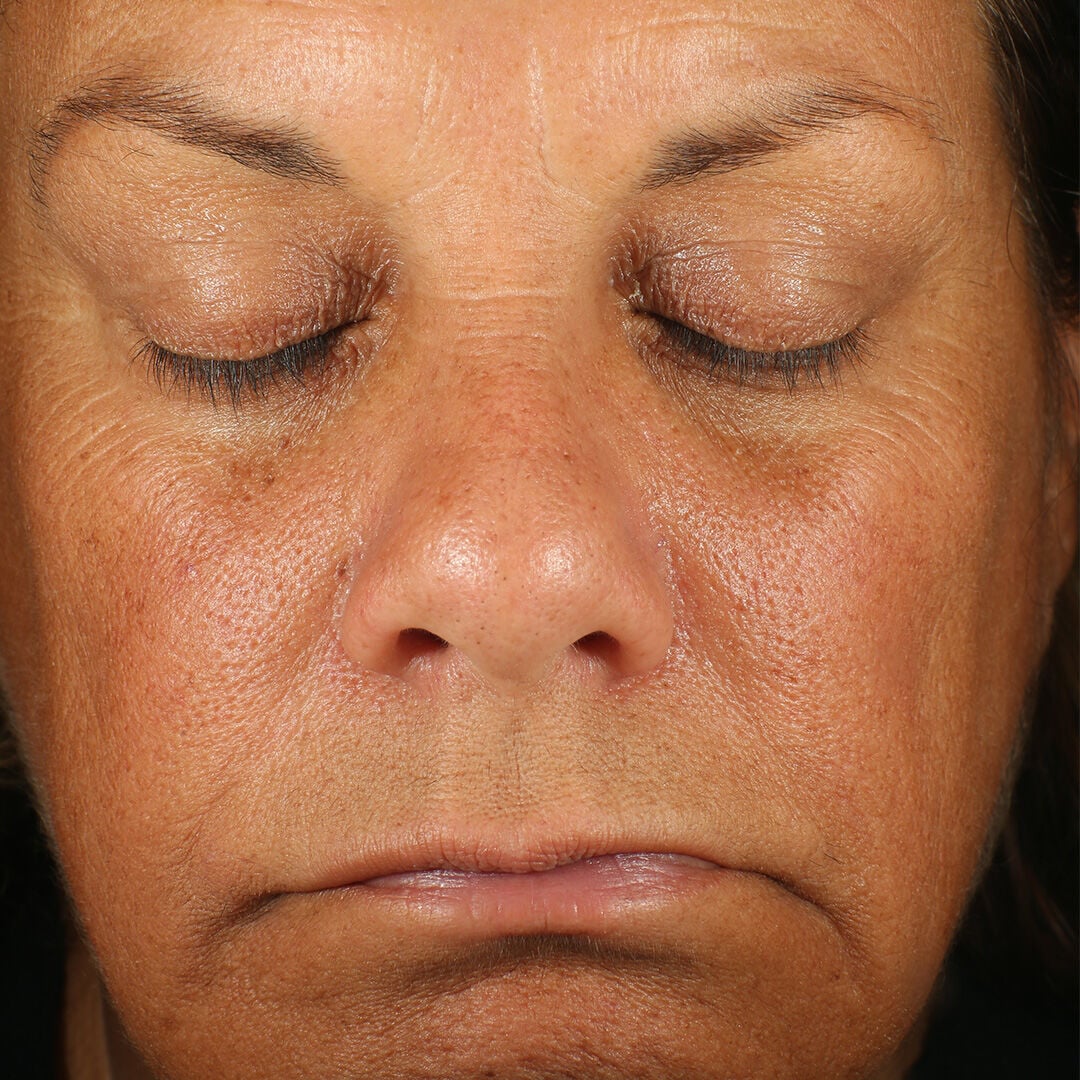 Retinol Skin Brightener 1 Percent  before-after-1